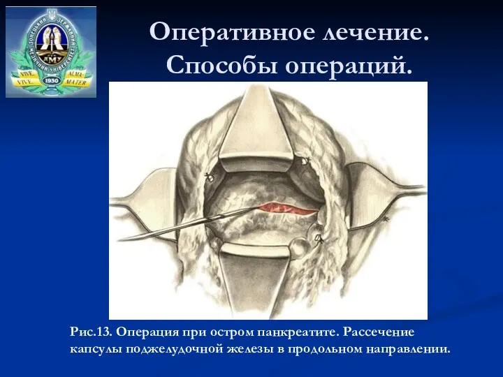 Оперативное лечение. Способы операций. Рис.13. Операция при остром панкреатите. Рассечение капсулы поджелудочной железы в продольном направлении.