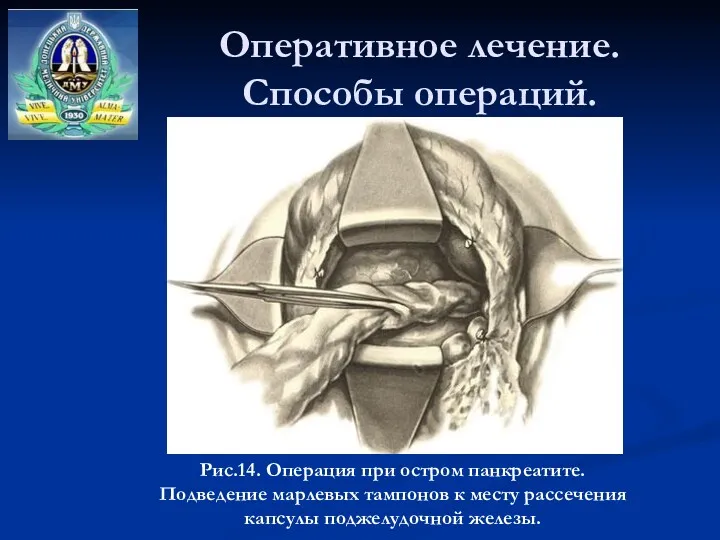 Оперативное лечение. Способы операций. Рис.14. Операция при остром панкреатите. Подведение