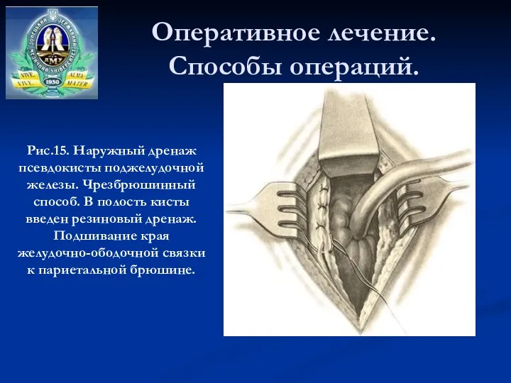 Оперативное лечение. Способы операций. Рис.15. Наружный дренаж псевдокисты поджелудочной железы.