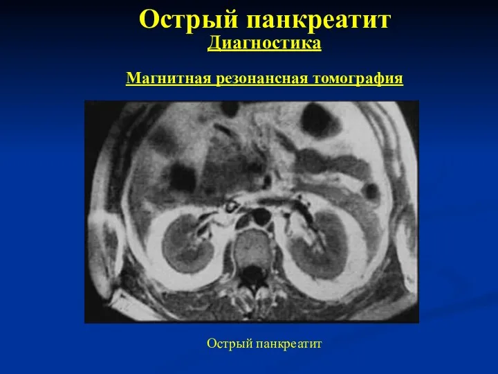 Острый панкреатит Диагностика Магнитная резонансная томография Острый панкреатит