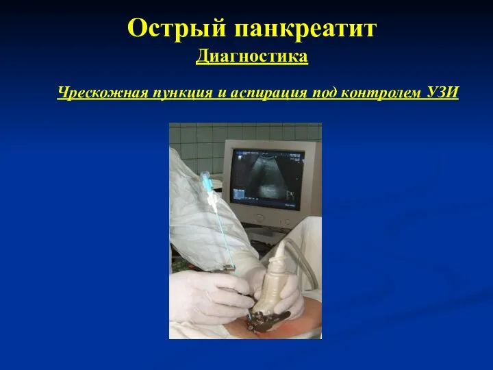 Острый панкреатит Диагностика Чрескожная пункция и аспирация под контролем УЗИ