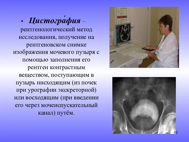 Цистогра́фия – рентгенологический метод исследования, получение на рентгеновском снимке изображения мочевого пузыря с