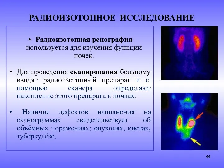 РАДИОИЗОТОПНОЕ ИССЛЕДОВАНИЕ Радиоизотопная ренография используется для изучения функции почек. Для проведения сканирования больному