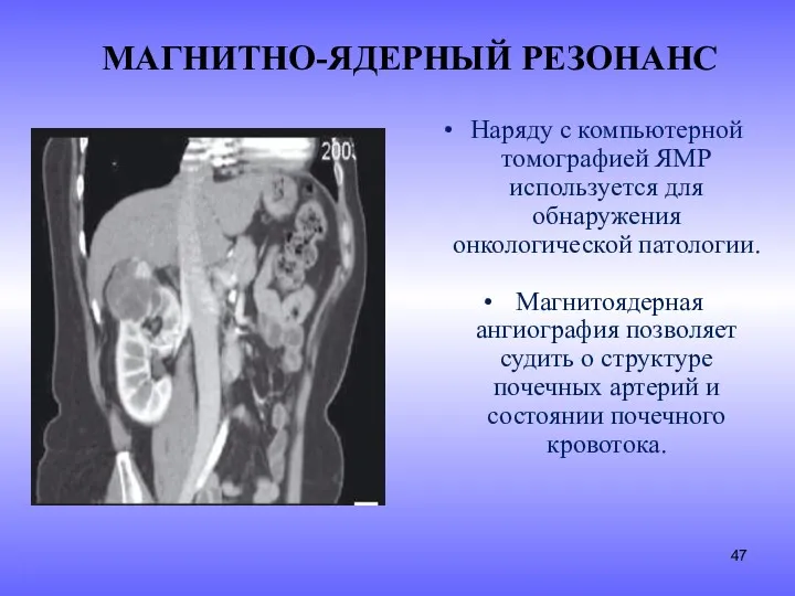 МАГНИТНО-ЯДЕРНЫЙ РЕЗОНАНС Наряду с компьютерной томографией ЯМР используется для обнаружения онкологической патологии. Магнитоядерная