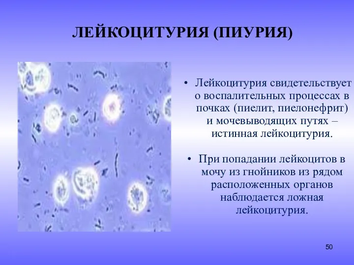 ЛЕЙКОЦИТУРИЯ (ПИУРИЯ) Лейкоцитурия свидетельствует о воспалительных процессах в почках (пиелит, пиелонефрит) и мочевыводящих