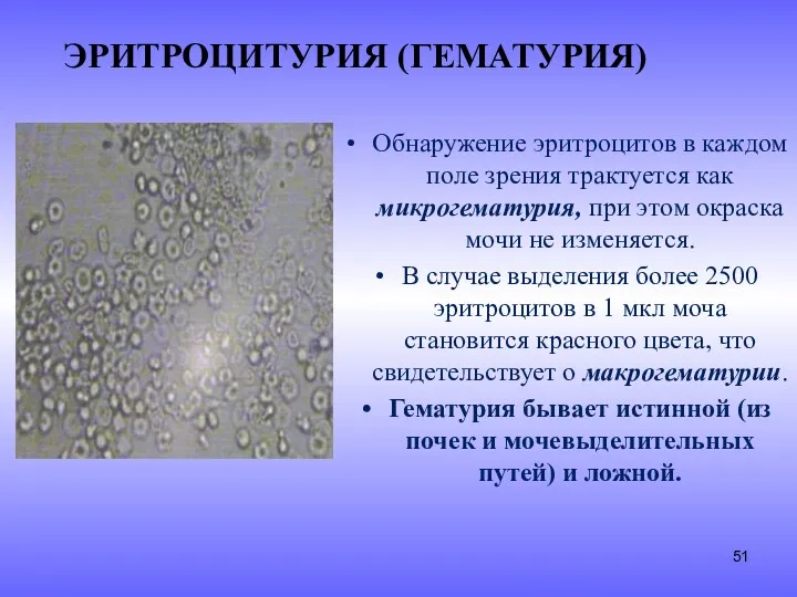 ЭРИТРОЦИТУРИЯ (ГЕМАТУРИЯ) Обнаружение эритроцитов в каждом поле зрения трактуется как микрогематурия, при этом