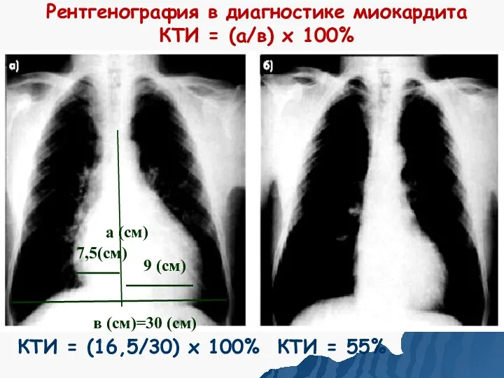 Рентгенография в диагностике миокардита КТИ = (а/в) х 100% 9 (см) в (см)=30