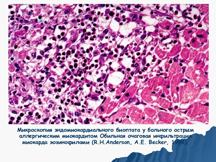 Микроскопия эндомиокардиального биоптата у больного острым аллергическим миокардитом Обильная очаговая инфильтрация миокарда эозинофилами