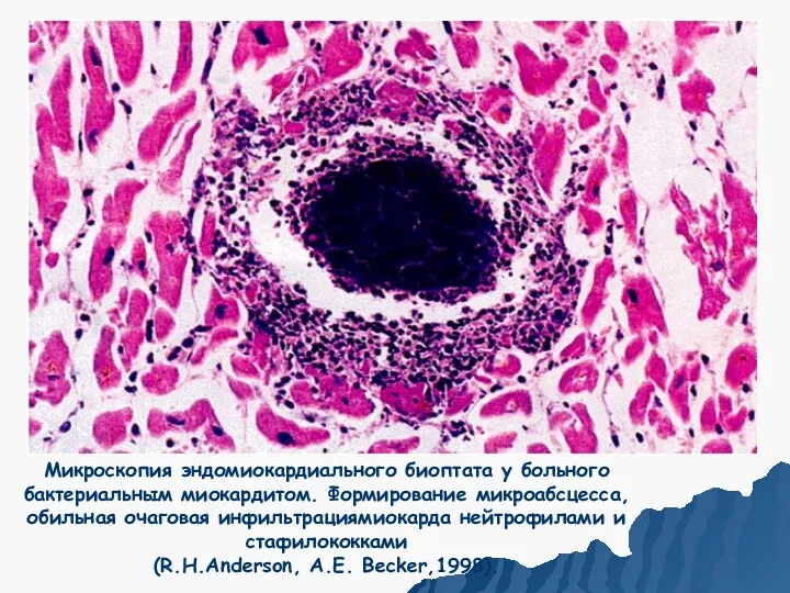 Микроскопия эндомиокардиального биоптата у больного бактериальным миокардитом. Формирование микроабсцесса, обильная очаговая инфильтрациямиокарда нейтрофилами