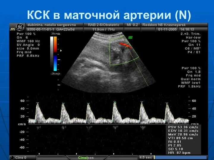 КСК в маточной артерии (N)