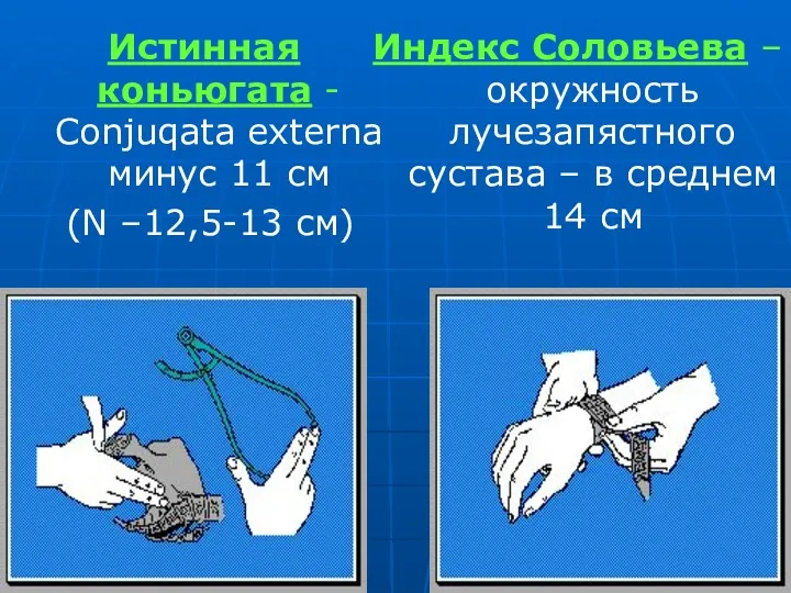 Истинная коньюгата - Cоnjuqata externa минус 11 см (N –12,5-13 см) Индекс Соловьева