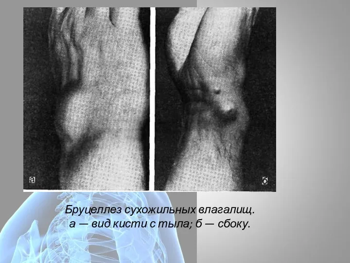 Бруцеллез сухожильных влагалищ. а — вид кисти с тыла; б — сбоку.