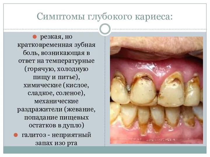 Симптомы глубокого кариеса: резкая, но кратковременная зубная боль, возникающая в