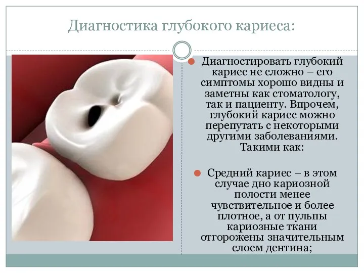 Диагностика глубокого кариеса: Диагностировать глубокий кариес не сложно – его