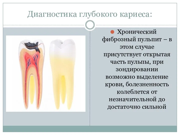 Диагностика глубокого кариеса: Хронический фиброзный пульпит – в этом случае