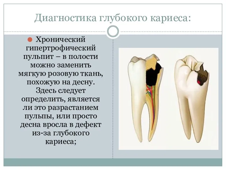 Диагностика глубокого кариеса: Хронический гипертрофический пульпит – в полости можно