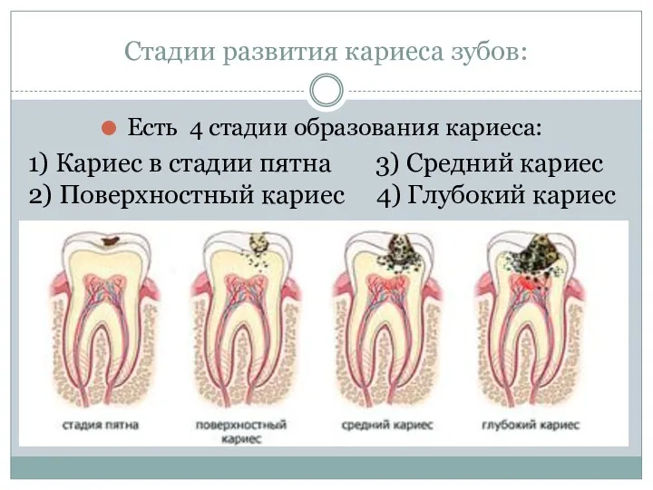 Стадии развития кариеса зубов: Есть 4 стадии образования кариеса: 1)