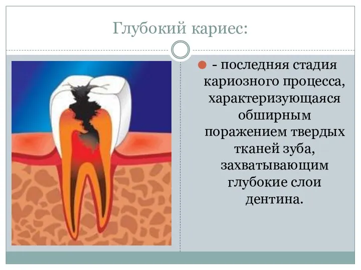 Глубокий кариес: - последняя стадия кариозного процесса, характеризующаяся обширным поражением