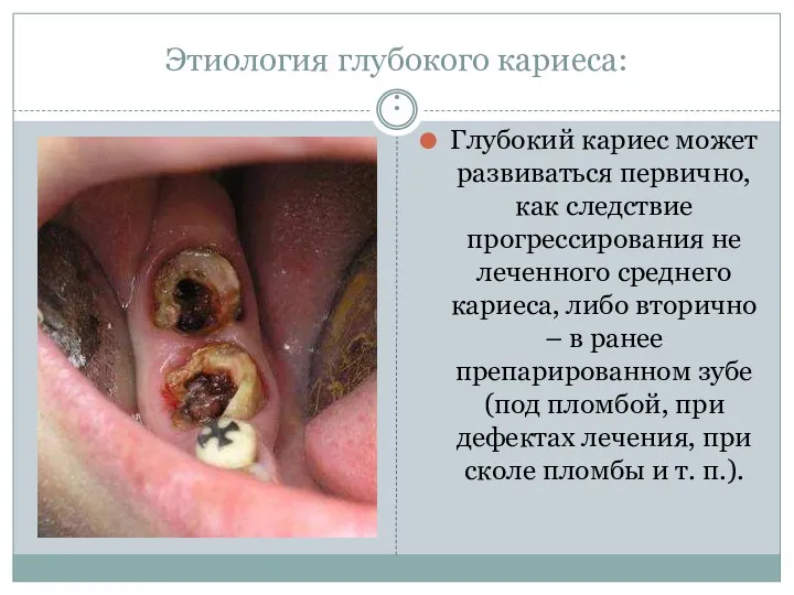 Этиология глубокого кариеса: : Глубокий кариес может развиваться первично, как