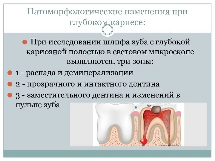 Патоморфологические изменения при глубоком кариесе: При исследовании шлифа зуба с