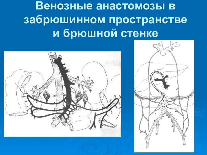 Венозные анастомозы в забрюшинном пространстве и брюшной стенке