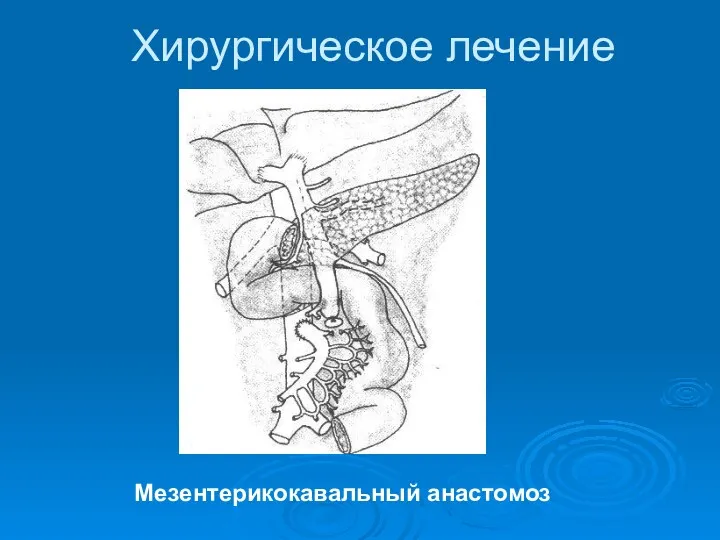 Хирургическое лечение Мезентерикокавальный анастомоз