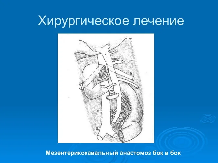 Хирургическое лечение Мезентерикокавальный анастомоз бок в бок