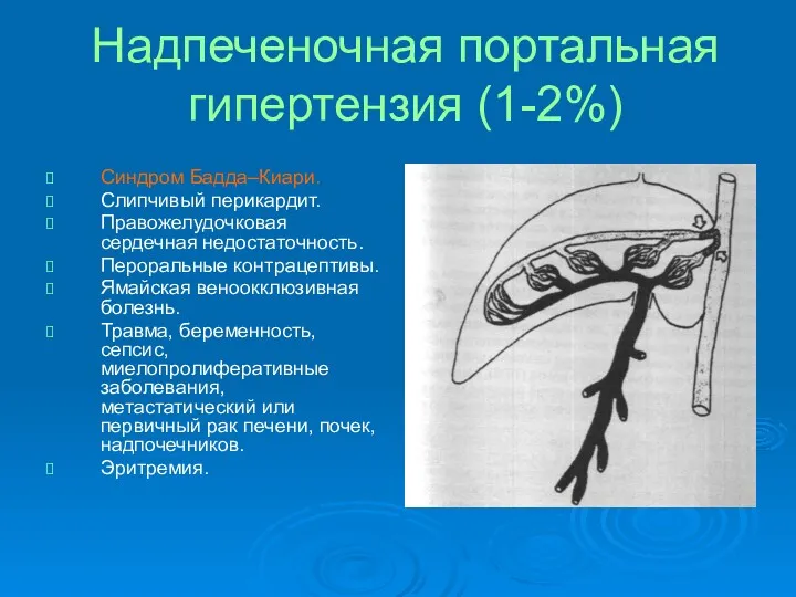 Надпеченочная портальная гипертензия (1-2%) Синдром Бадда–Киари. Слипчивый перикардит. Правожелудочковая сердечная