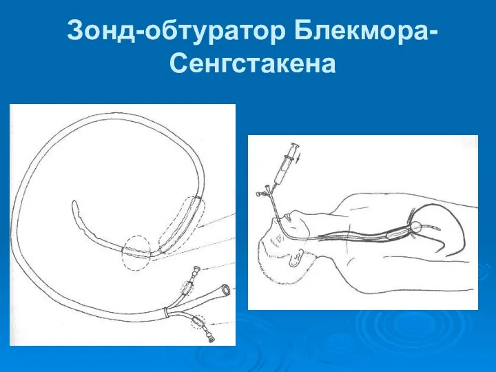 Зонд-обтуратор Блекмора-Сенгстакена