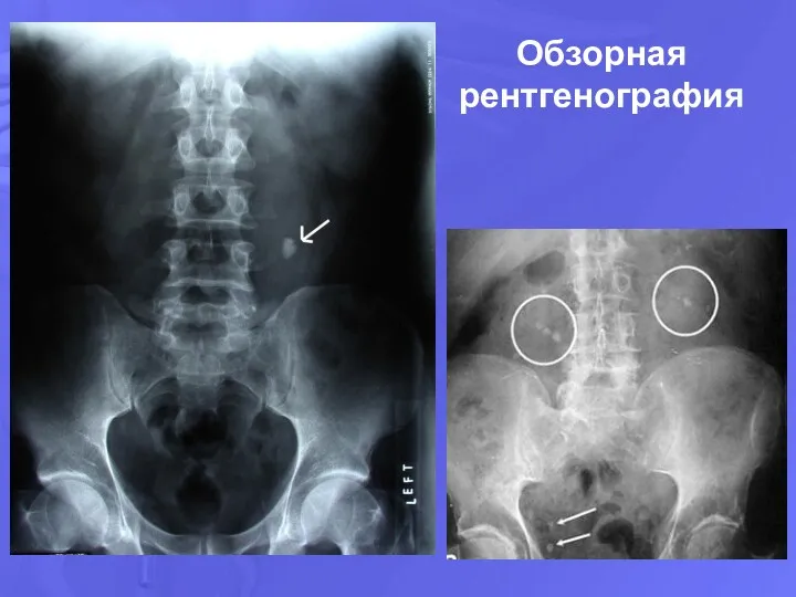 Обзорная рентгенография