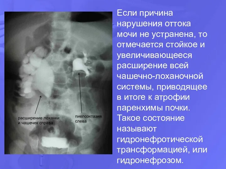 Если причина нарушения оттока мочи не устранена, то отмечается стойкое