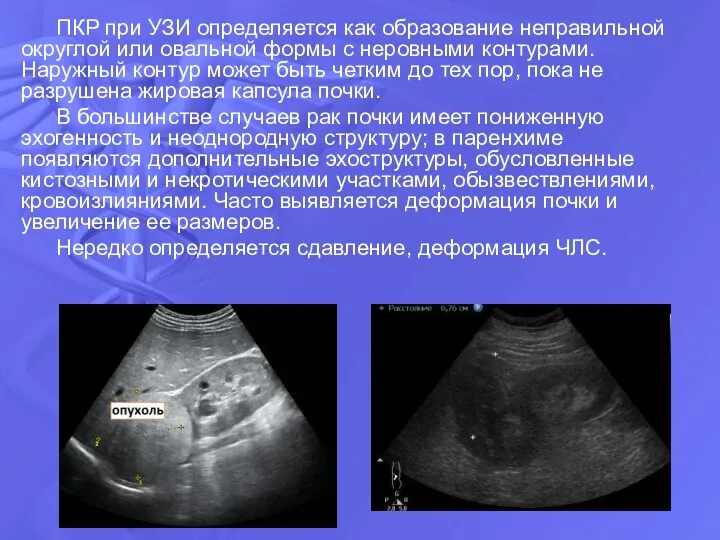 ПКР при УЗИ определяется как образование неправильной округлой или овальной