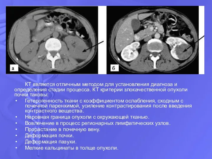 КТ является отличным методом для установления диагноза и определения стадии