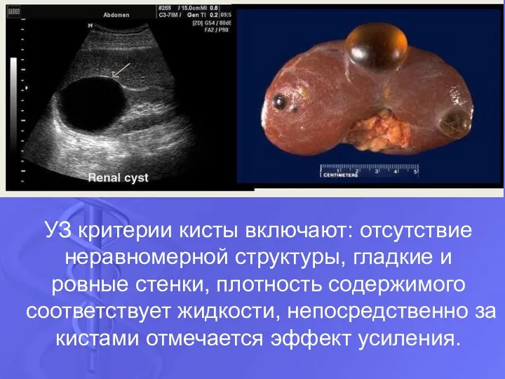 УЗ критерии кисты включают: отсутствие неравномерной структуры, гладкие и ровные