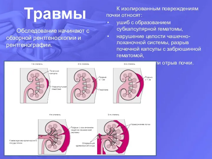 Травмы К изолированным повреждениям почки относят: ушиб с образованием субкапсулярной