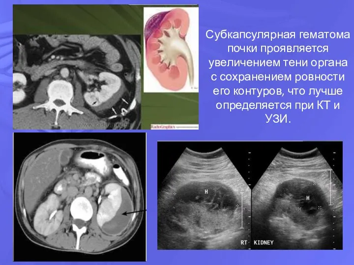 Субкапсулярная гематома почки проявляется увеличением тени органа с сохранением ровности