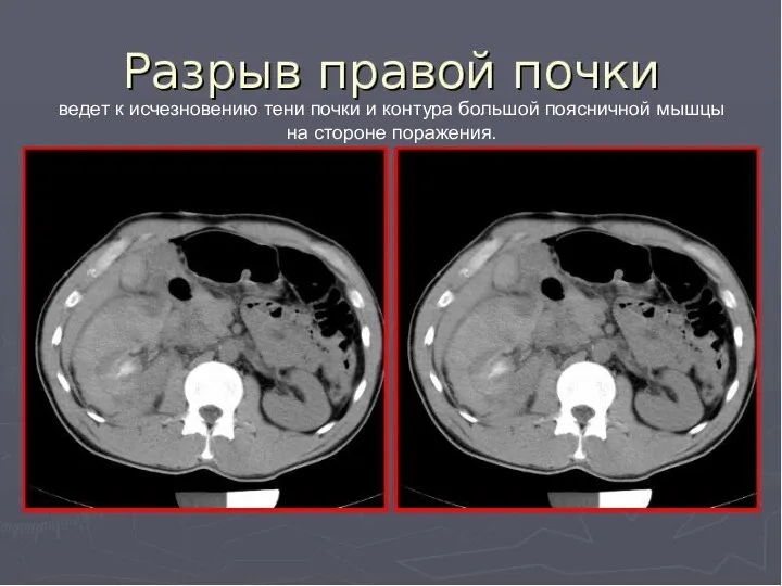 ведет к исчезновению тени почки и контура большой поясничной мышцы на стороне поражения.