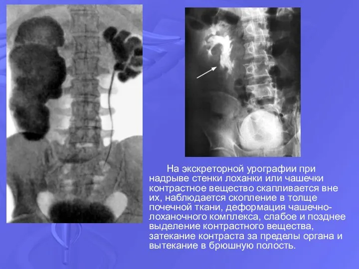 На экскреторной урографии при надрыве стенки лоханки или чашечки контрастное