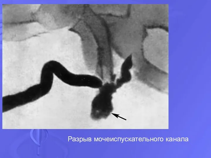 Разрыв мочеиспускательного канала