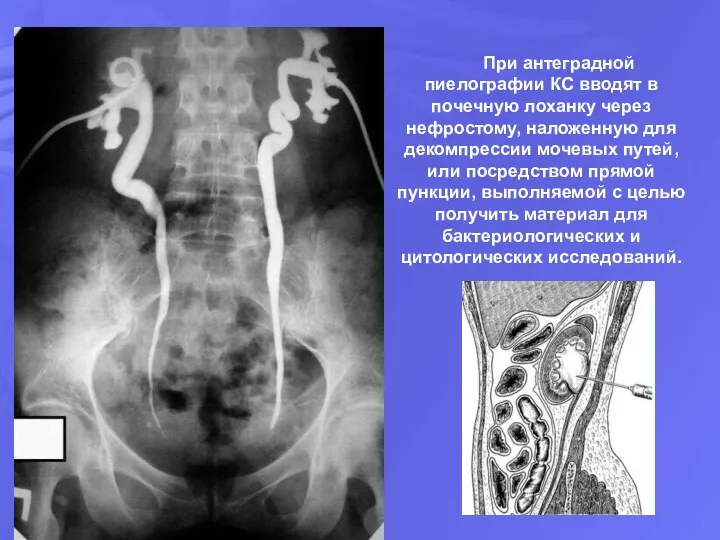 При антеградной пиелографии КС вводят в почечную лоханку через нефростому,