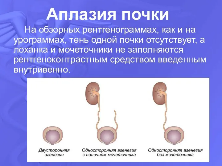 Аплазия почки На обзорных рентгенограммах, как и на урограммах, тень