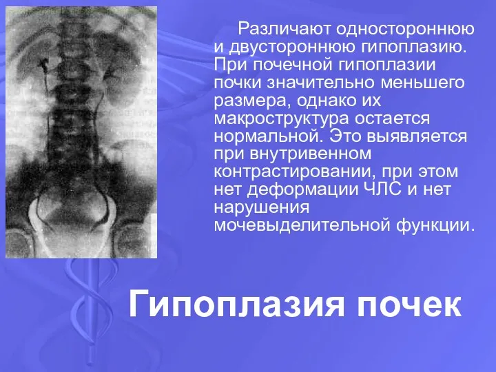 Гипоплазия почек Различают одностороннюю и двустороннюю гипоплазию. При почечной гипоплазии