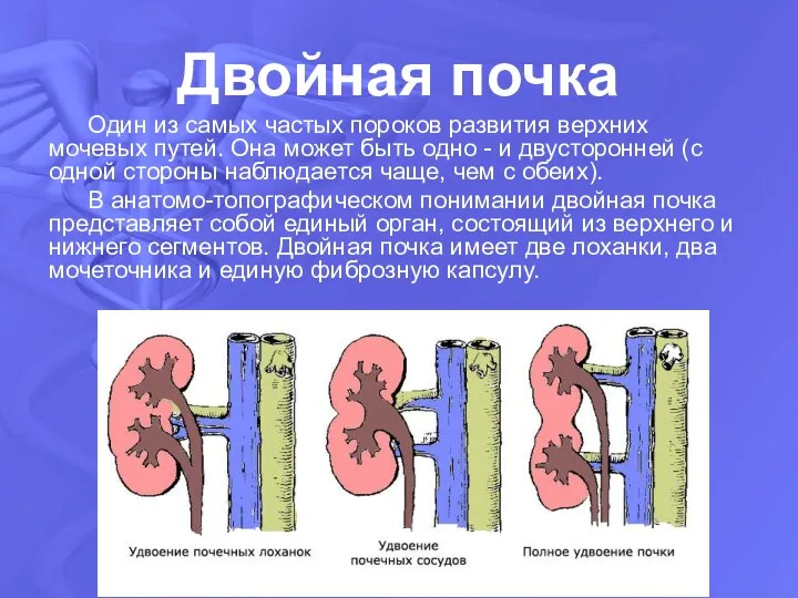 Двойная почка Один из самых частых пороков развития верхних мочевых