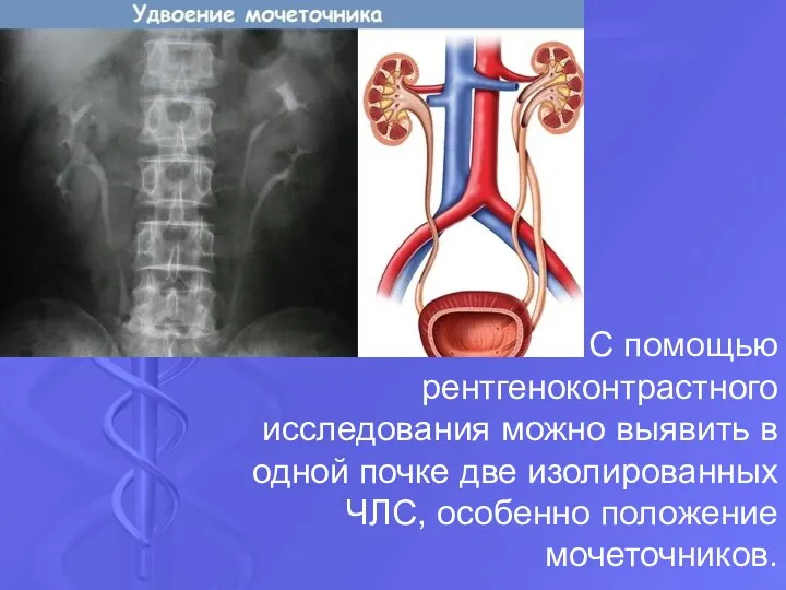 С помощью рентгеноконтрастного исследования можно выявить в одной почке две изолированных ЧЛС, особенно положение мочеточников.