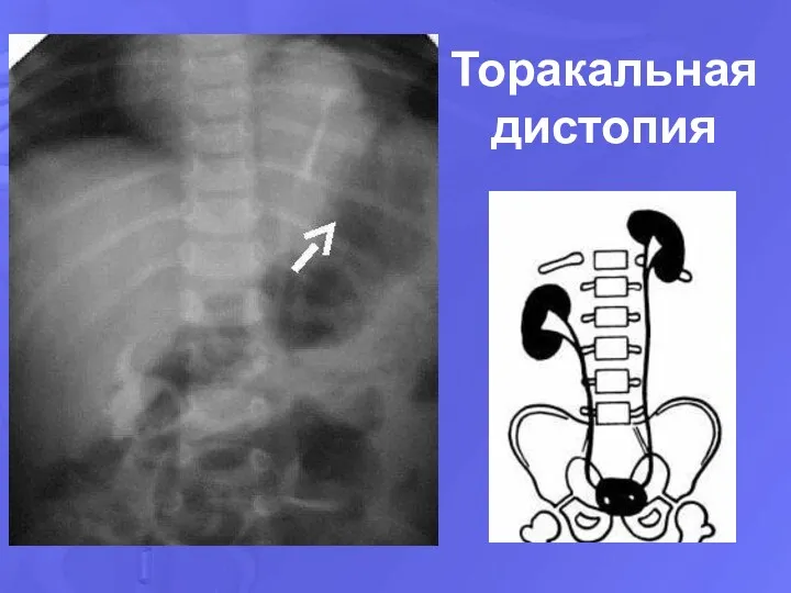 Торакальная дистопия