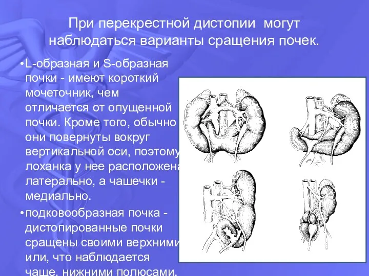 При перекрестной дистопии могут наблюдаться варианты сращения почек. L-oбразная и