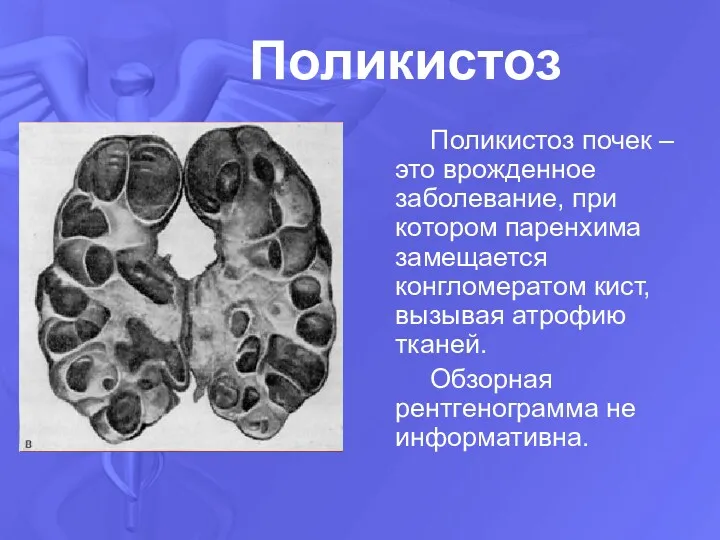 Поликистоз Поликистоз почек – это врожденное заболевание, при котором паренхима