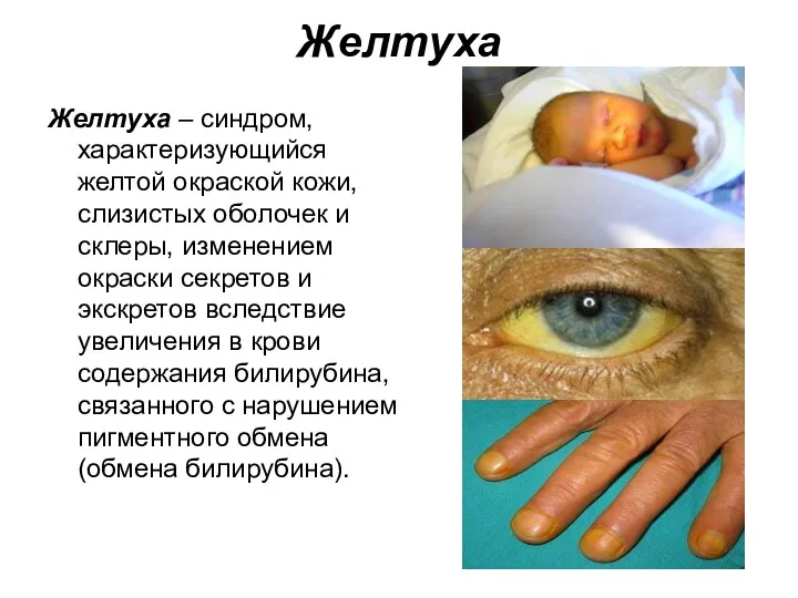 Желтуха Желтуха – синдром, характеризующийся желтой окраской кожи, слизистых оболочек
