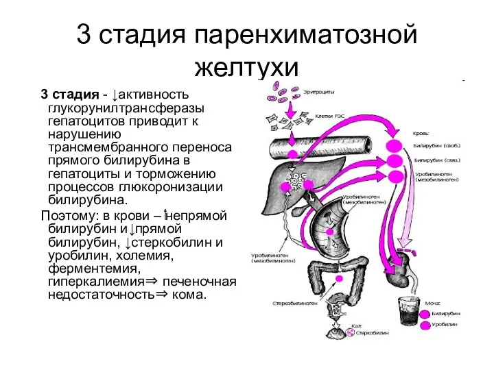 3 стадия паренхиматозной желтухи 3 стадия - ↓активность глукорунилтрансферазы гепатоцитов