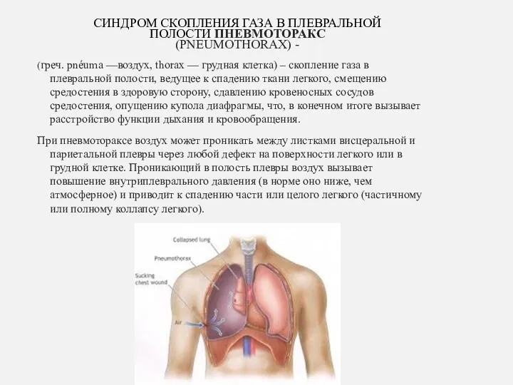 СИНДРОМ СКОПЛЕНИЯ ГАЗА В ПЛЕВРАЛЬНОЙ ПОЛОСТИ ПНЕВМОТОРАКС (PNEUMOTHORAX) - (греч. pnéuma —воздух, thorax
